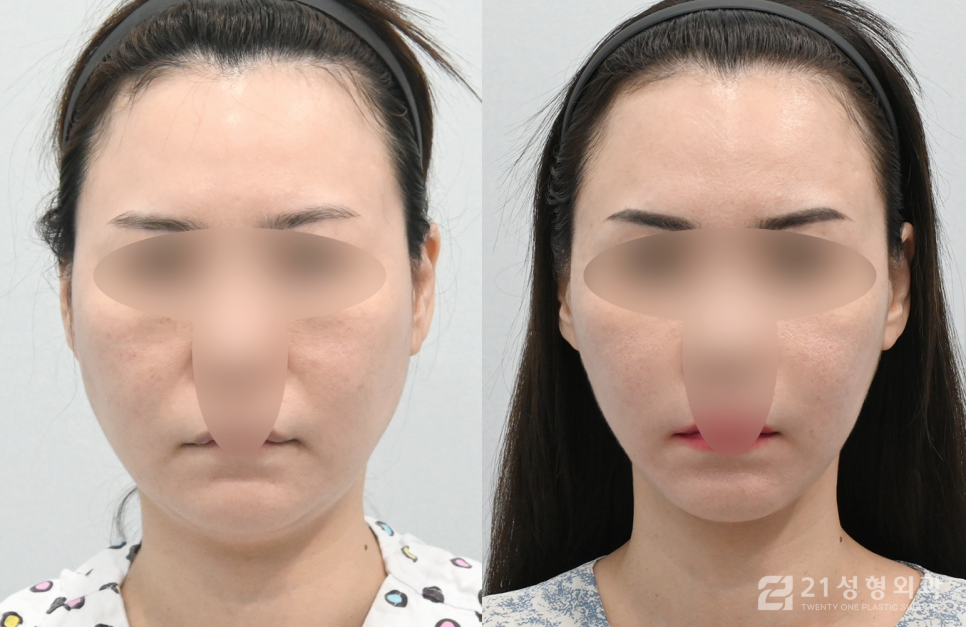턱밑침샘개선방법으로 이중턱 얼굴라인을 갸름하게 관련 이미지 1