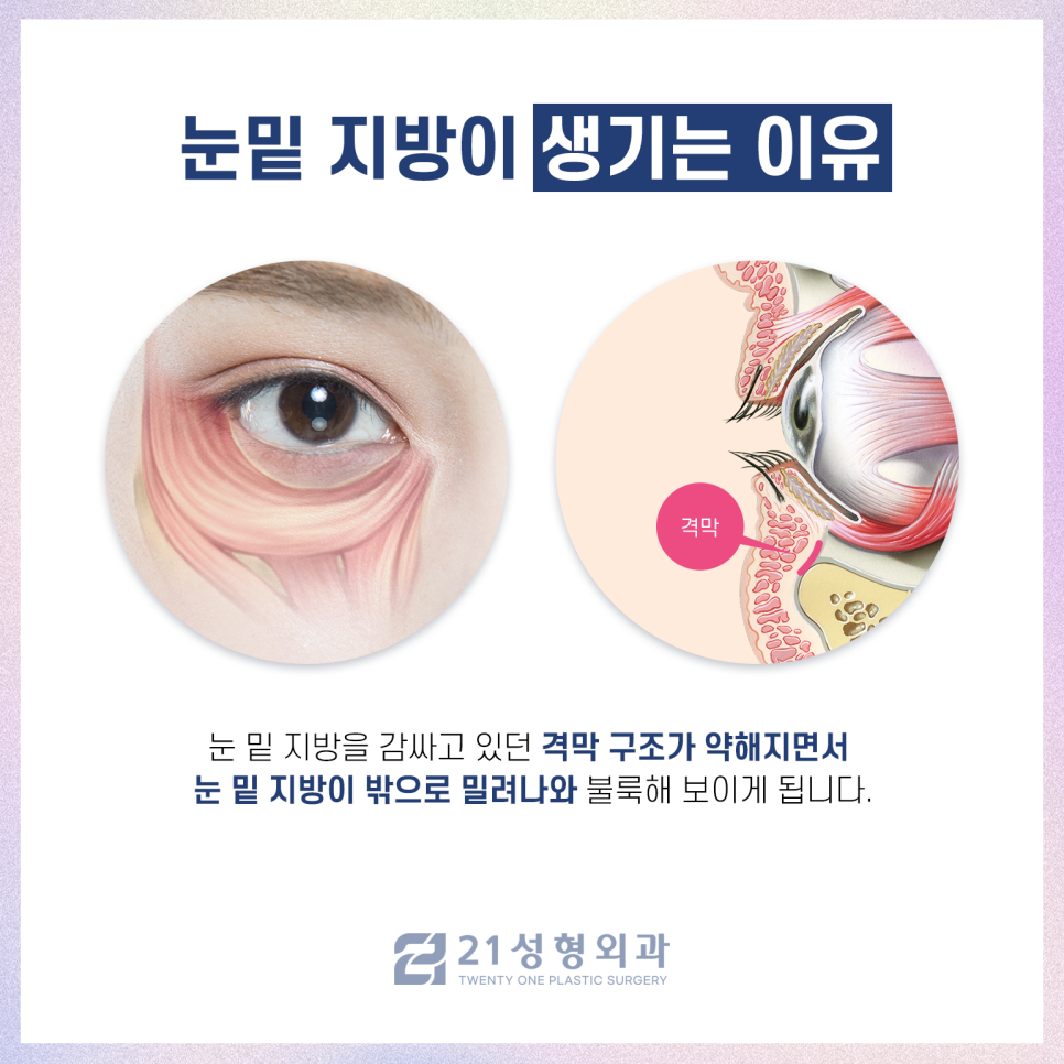 눈밑지방재배치병원 선택 시 고려해야 하는 것 관련 이미지 2