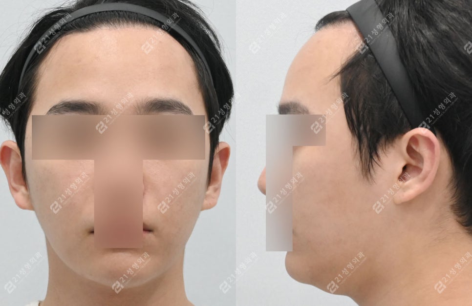 살은 안 쪘는데 왜 이중턱만 남을까? 남자 이중턱의 진짜 원인 관련 이미지 1