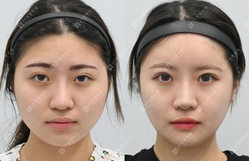 Real Review of Square Jaw Surgery: Square Jaw Surgery Is Not Over After Just Shaving the Bone image 1