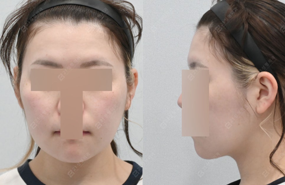 Can I Have a Clean Jawline Too? A Real Review of Double Chin Removal image 4