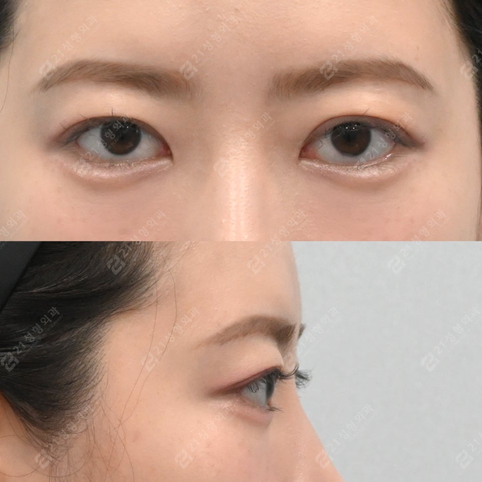 애교와 눈밑지방재배치는 왜 함께 고려해야 할까? 관련 이미지 5