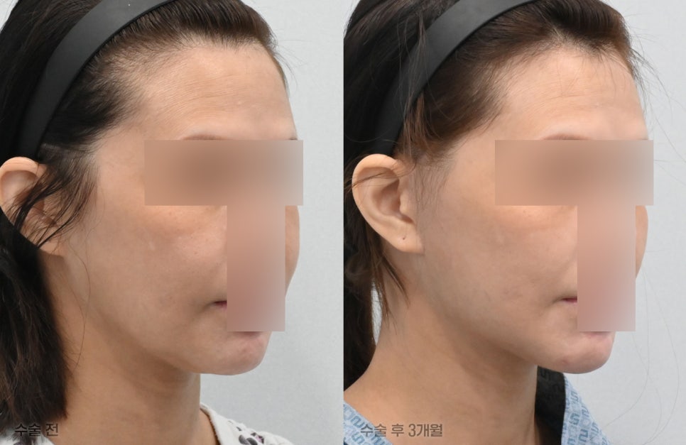 Pixie Ears After a Facelift: Why Do They Differ from Clinic to Clinic? Find Out at 21 Plastic Surgery image 3