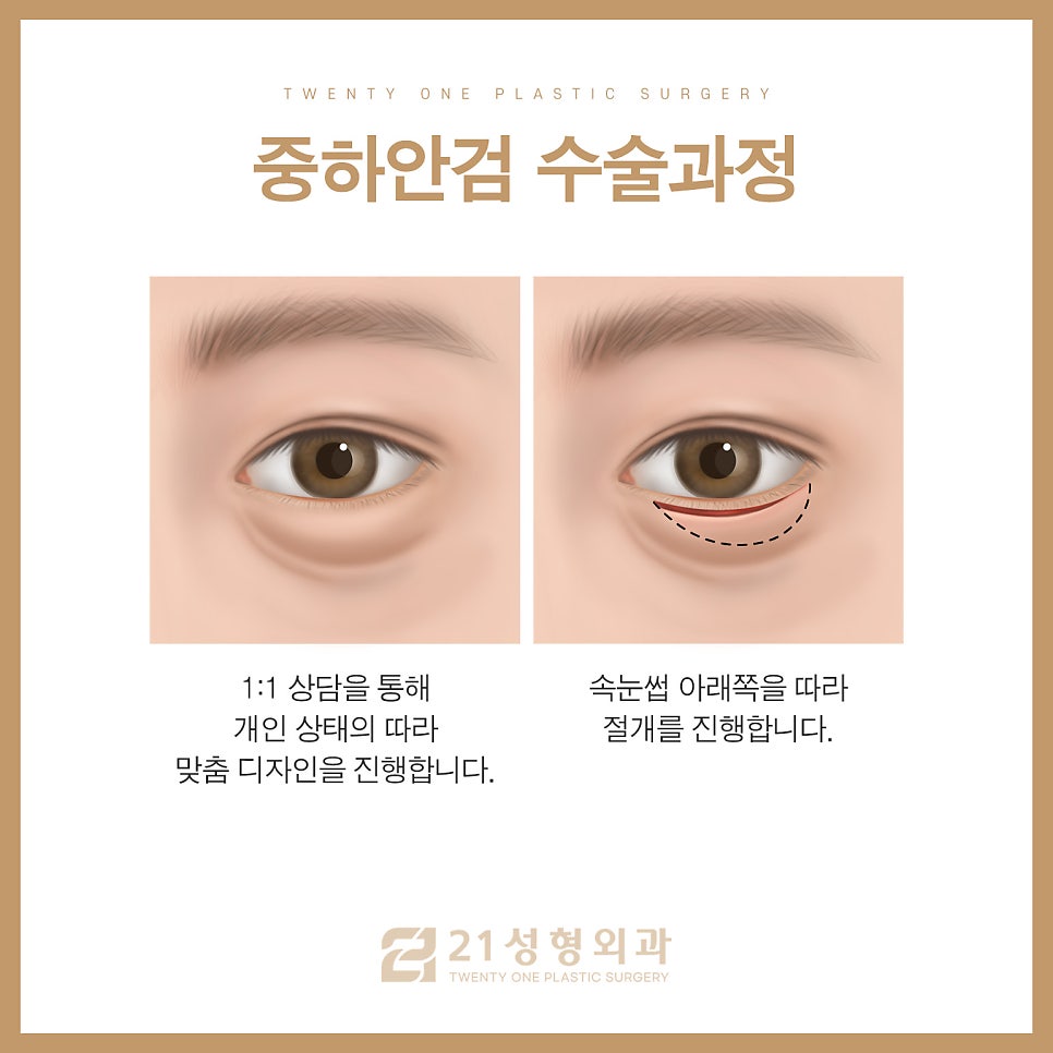 중년하안검 흉터 미리 방지 가능합니다 관련 이미지 6