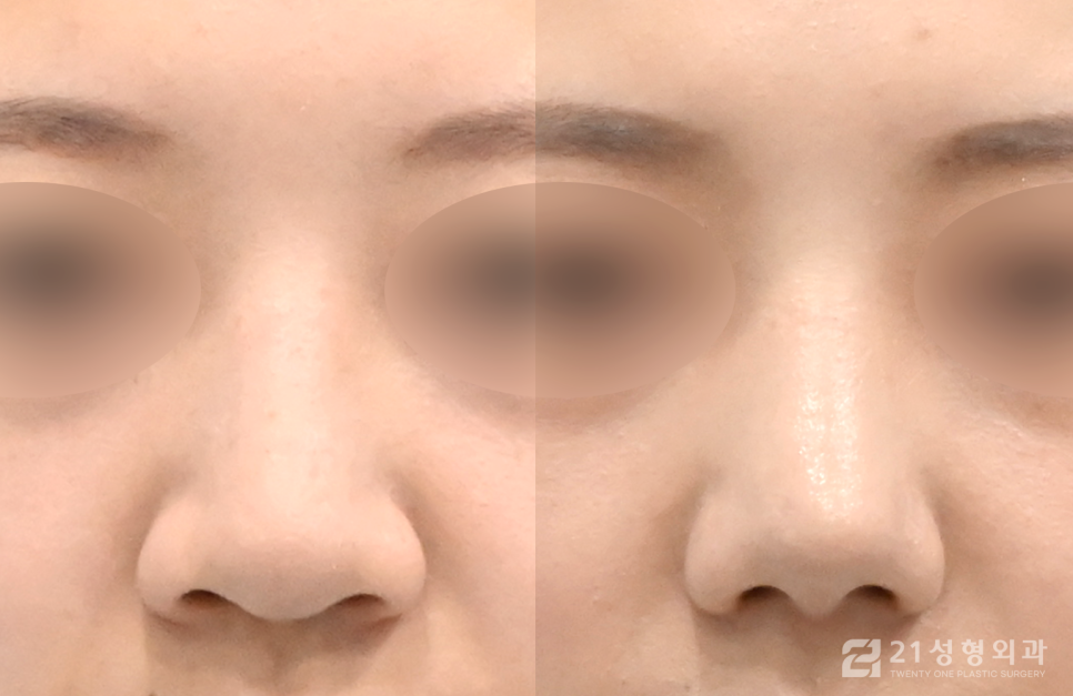 코성형잘하는곳 개인에게 맞는 자연스러운 비율 관련 이미지 1