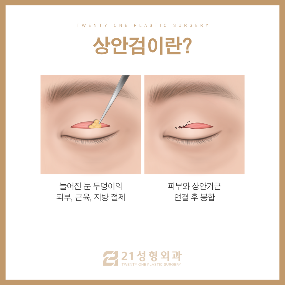 중년눈수술로 꽃중년 소리 들을 수 있습니다 관련 이미지 5