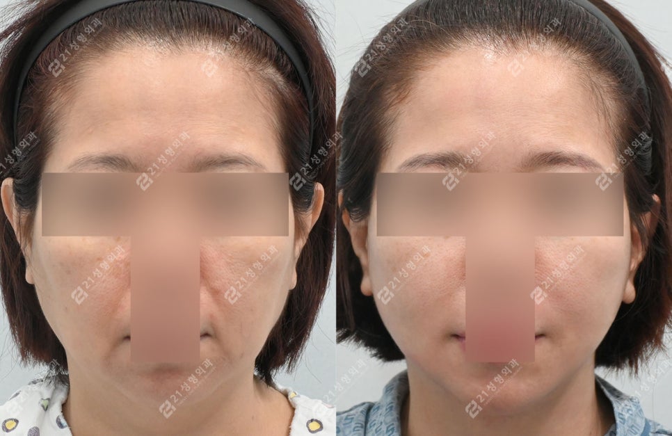 거상 수술의 효과를 극대화하는 방법, 안면목거상 + 근육묶기 케이스 관련 이미지 6