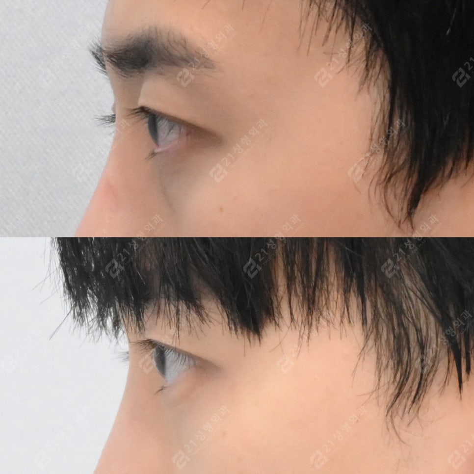 Before-and-After Case of Lower Eyelid Fat Repositioning Surgery for Men image 6