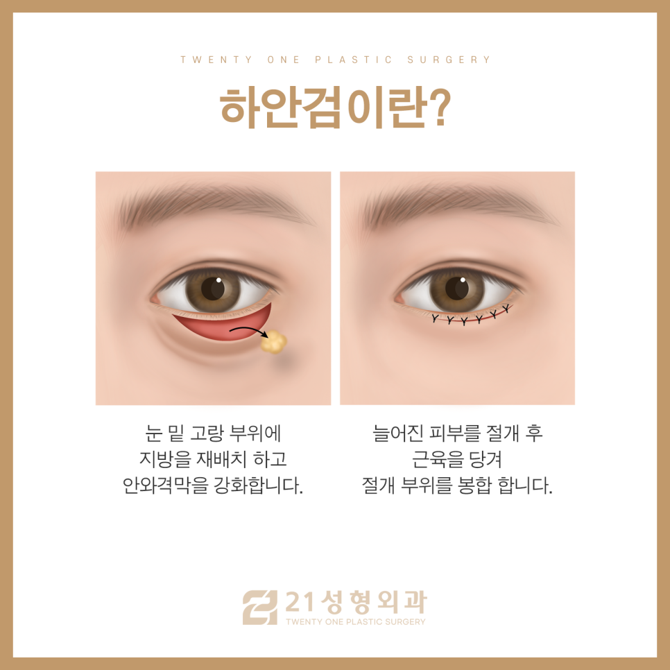 중년눈수술로 꽃중년 소리 들을 수 있습니다 관련 이미지 6