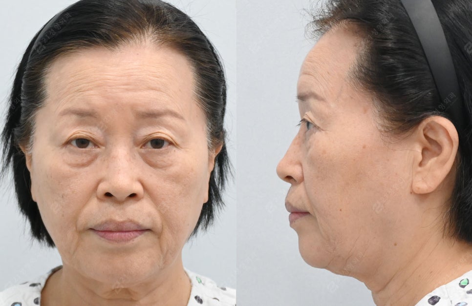 자연스럽게 젊어지고 싶다면? 중년 수술 이마거상, 상.하안검으로 해결! 관련 이미지 2
