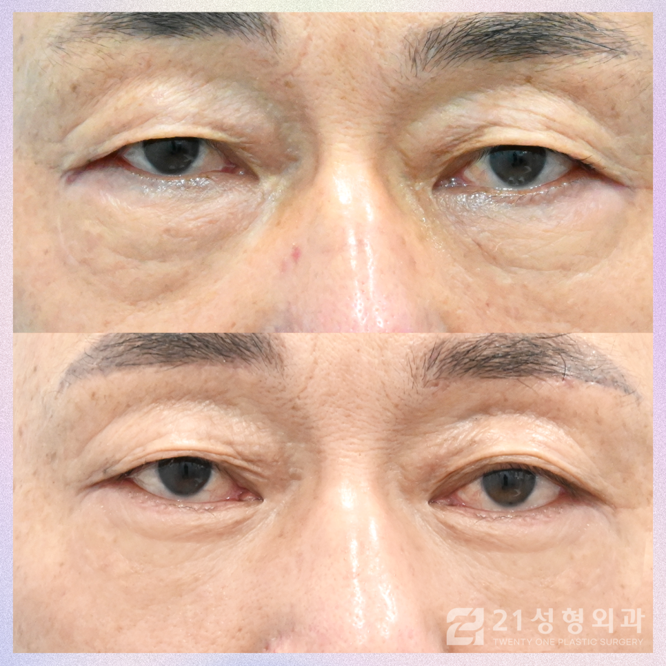 강남하안검수술 처짐 없는 동안 눈매를 위해 관련 이미지 1