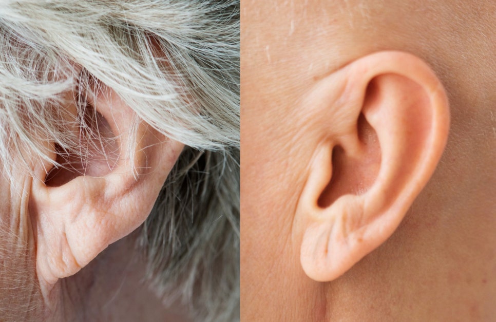Fae Ear Filler Progress Before and After 3 Months image 1