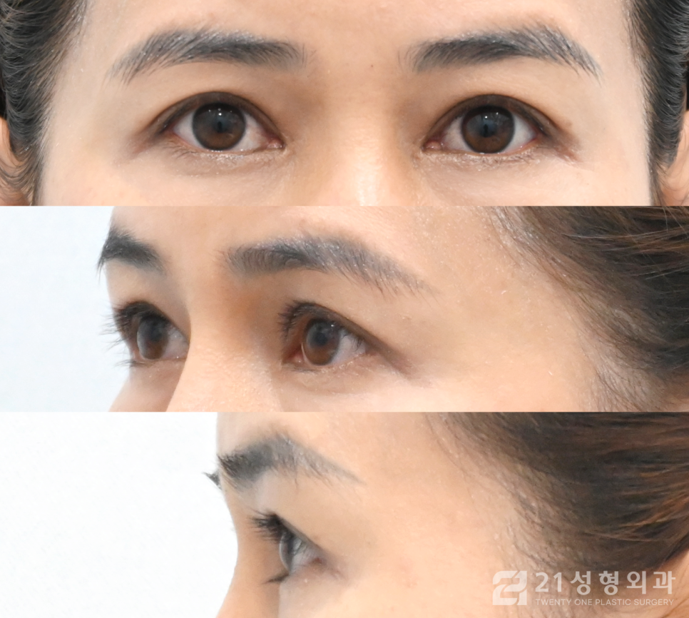 눈매교정잘하는곳 또렷해지고 싶다면 관련 이미지 5