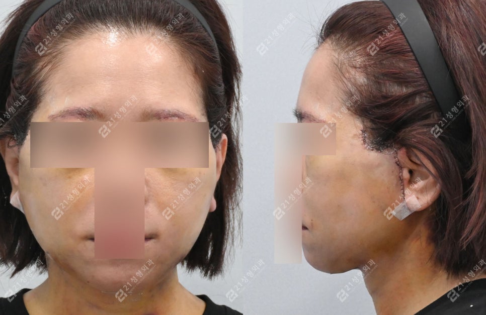거상 수술의 효과를 극대화하는 방법, 안면목거상 + 근육묶기 케이스 관련 이미지 3