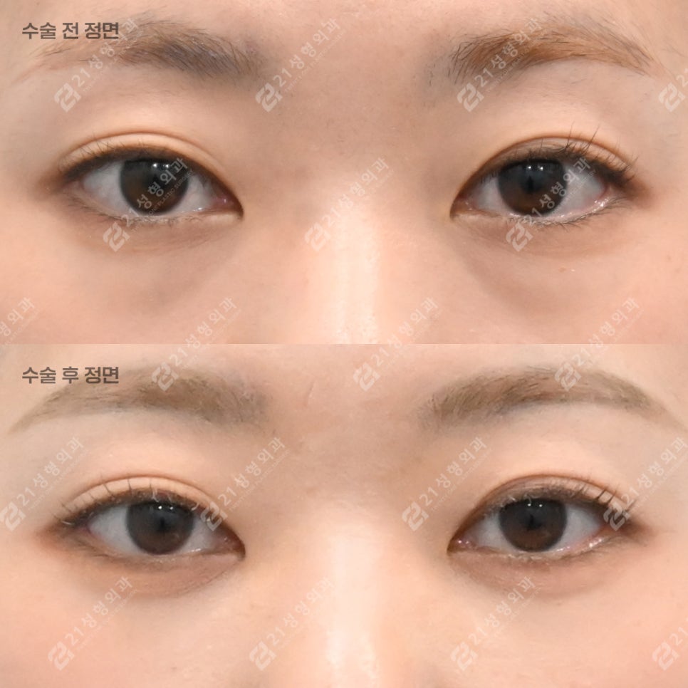 눈밑지방재배치를 받았는데 애교살이 없어졌어요 관련 이미지 1