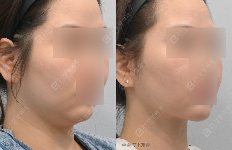 이중턱, 만져보면 원인이 보입니다 -21성형외과가 4가지로 나누는 이유 관련 이미지 5