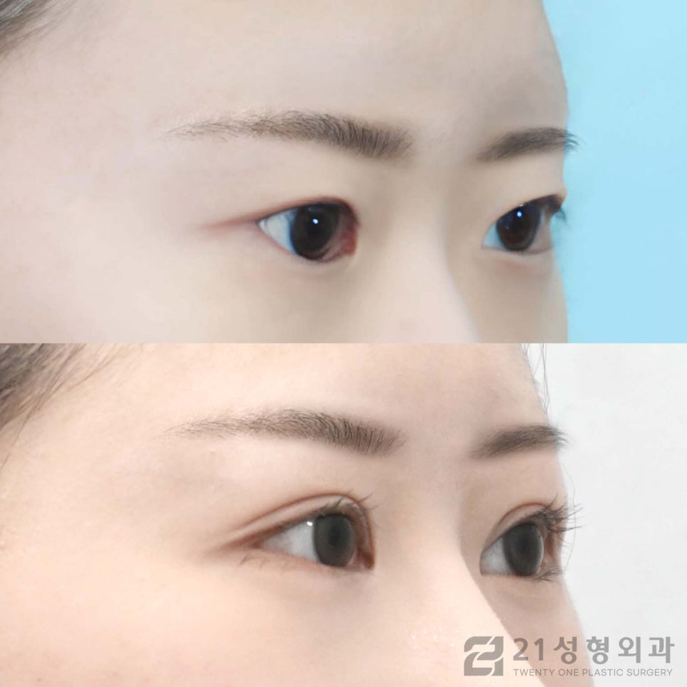 절개쌍수 특징적인 점에 대하여 관련 이미지 2