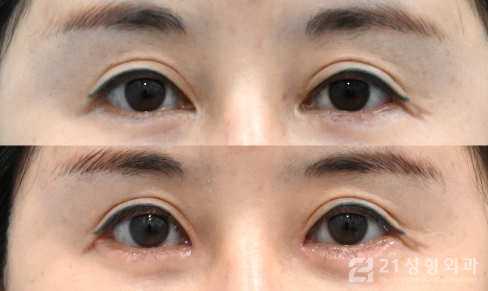 앞트임복원성형외과 잘하는 곳의 특징 관련 이미지 1