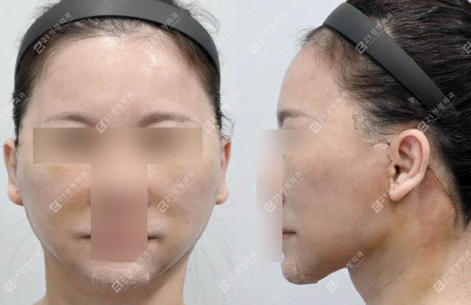 A Face That Needed a Lift, Not a Thread Lift — and There Was a Reason image 2