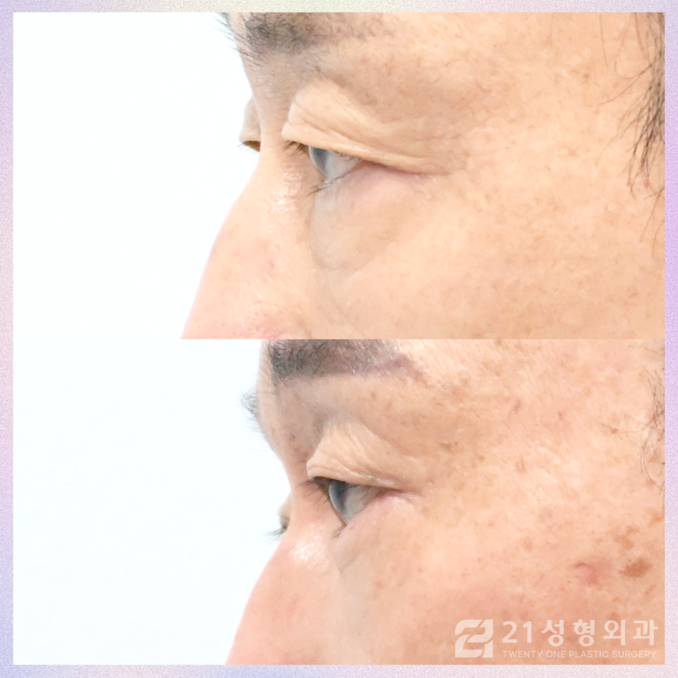 강남하안검수술 처짐 없는 동안 눈매를 위해 관련 이미지 5
