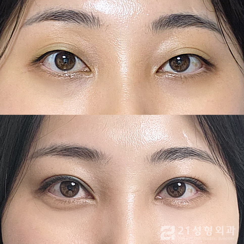 눈밑지방재배치잘하는곳 최고의 선택을 위해서는 관련 이미지 1
