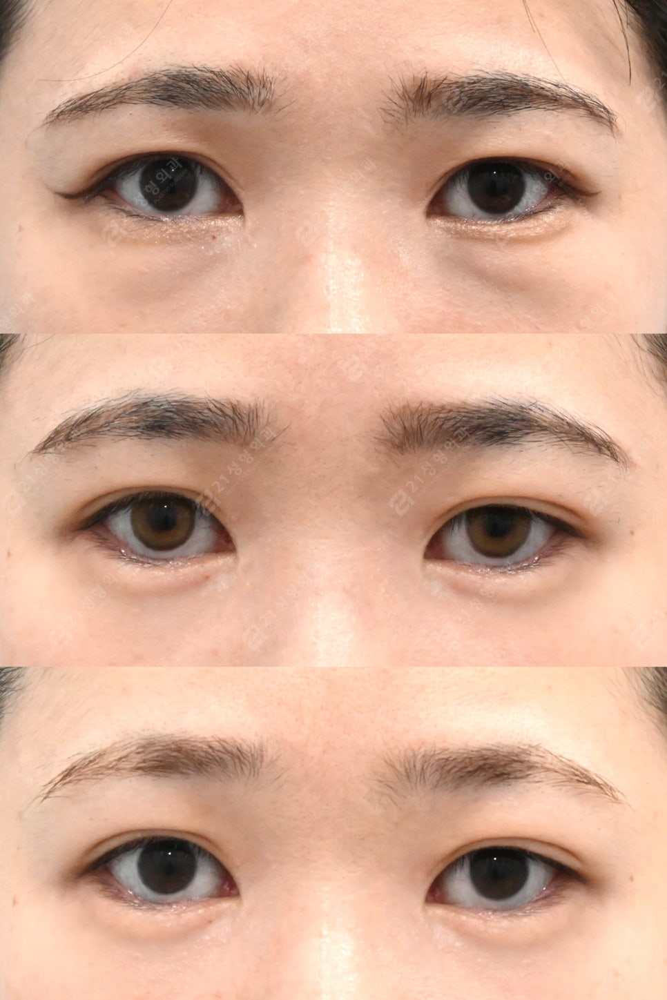 Under-eye fat that filler couldn’t hide: a 3-month and 4-month review after under-eye surgery image 5