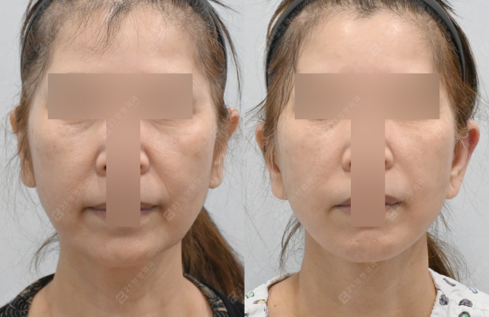 Facelift Surgery Without a Pulled Earlobe: A Real Patient Review image 1