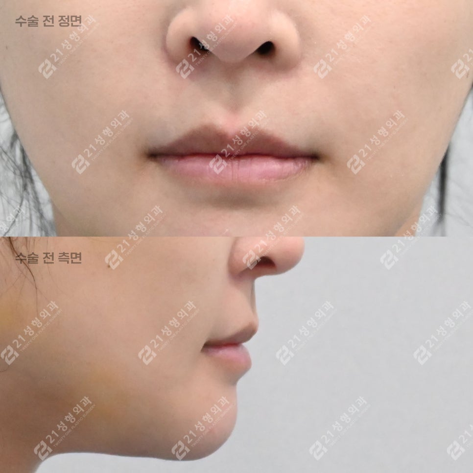 A Lip-Philtrum Reduction Surgery Case: Why Philtrum Dimple Surgery Was Performed Together image 3
