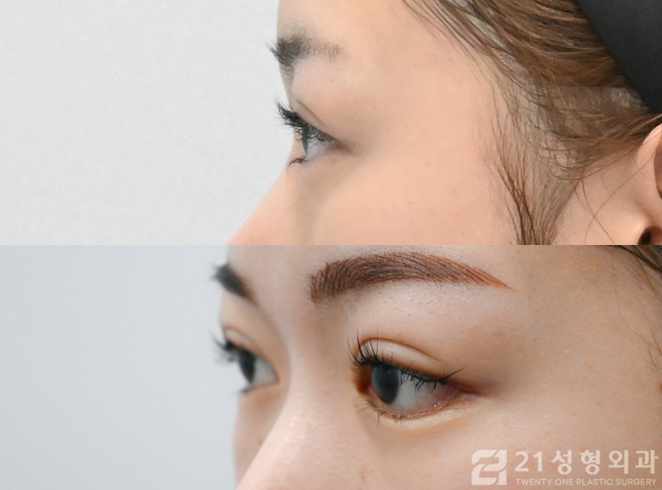 재발하기 않는 밑트임 방법 21성형외과 관련 이미지 3