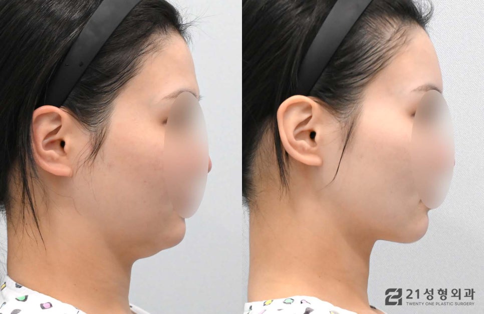 얼굴자가지방이식수술 유지기간과 효과 관련 이미지 3