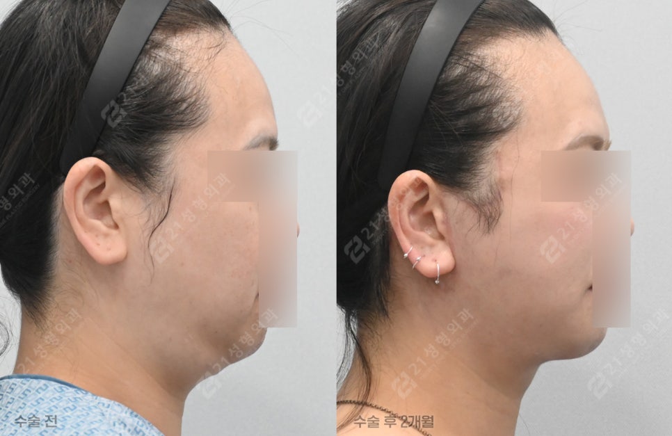 Why Does My Face Still Look the Same Even After Having Many Lifting Procedures? image 3