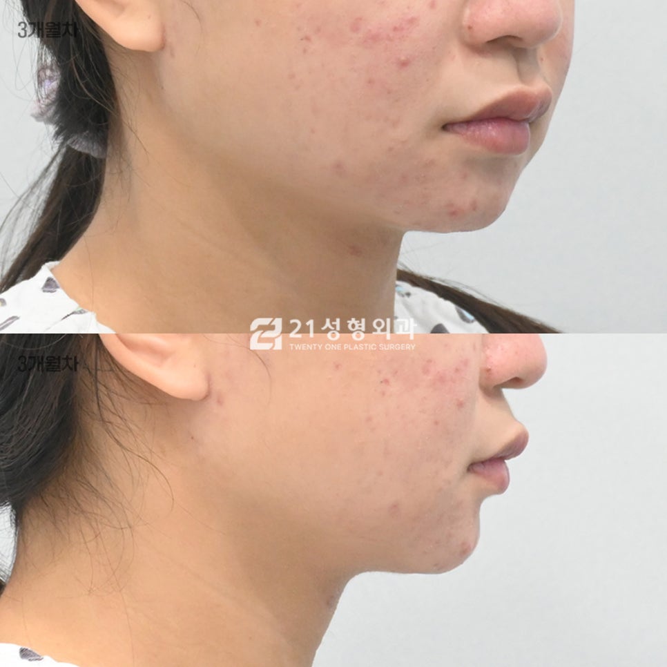 스트레스인 턱밑 살, 진짜 범인은 따로 있습니다. 관련 이미지 6