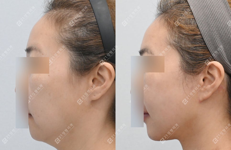 Facial and Neck Lift: The Key Is Structure, Not Skin | Real Before-and-After Review image 8