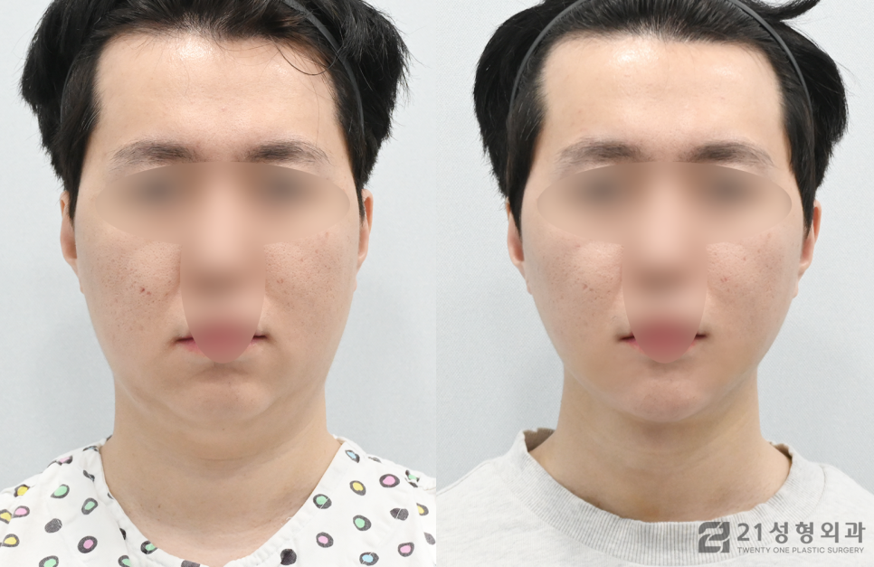 이중턱살빼는방법 갸름한 얼굴라인 비결 관련 이미지 1