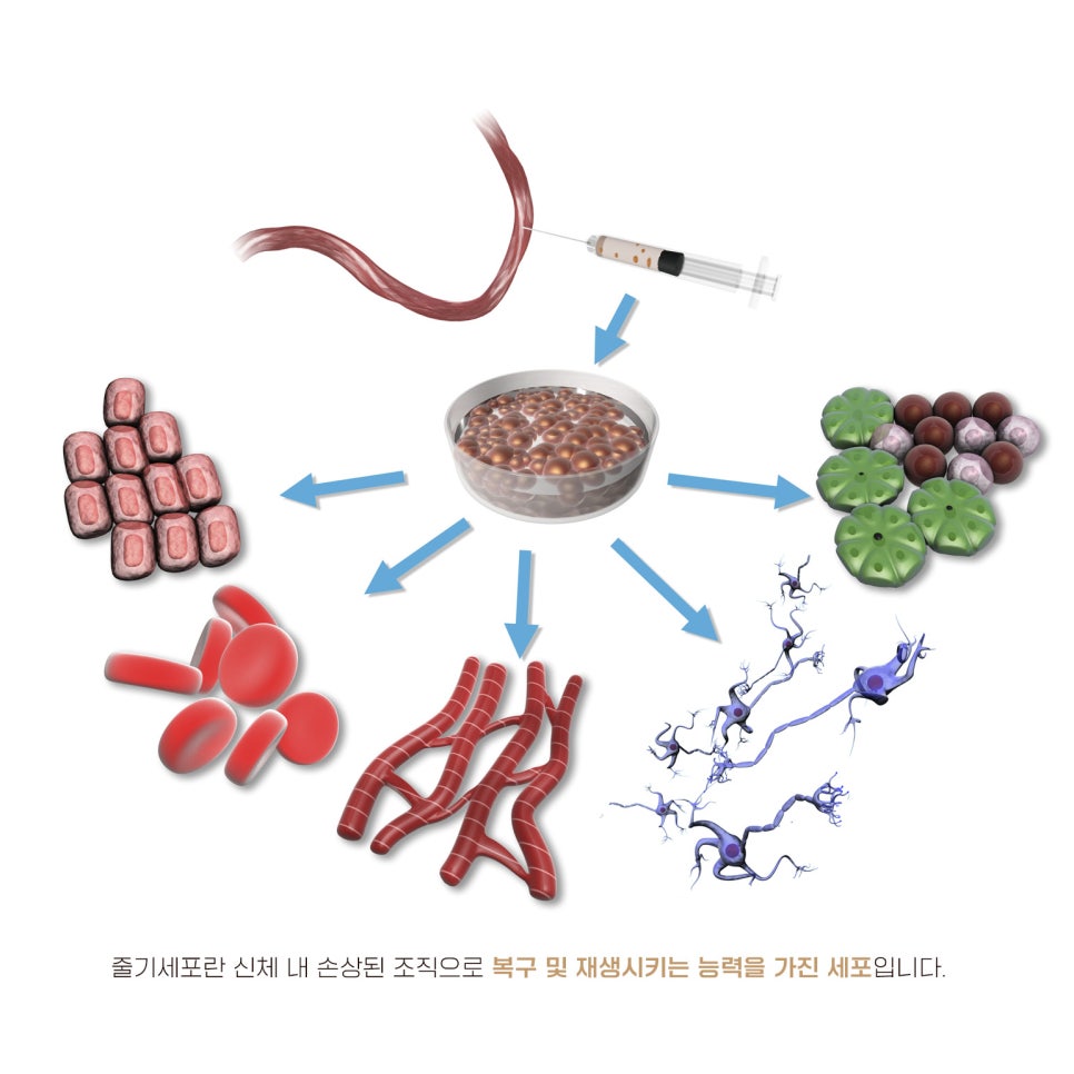 자가줄기세포가 가져온 무릎 통증 치료의 새 시대 관련 이미지 3