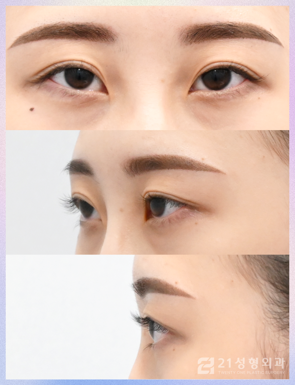 눈트임성형으로 크고 선명하게 관련 이미지 6