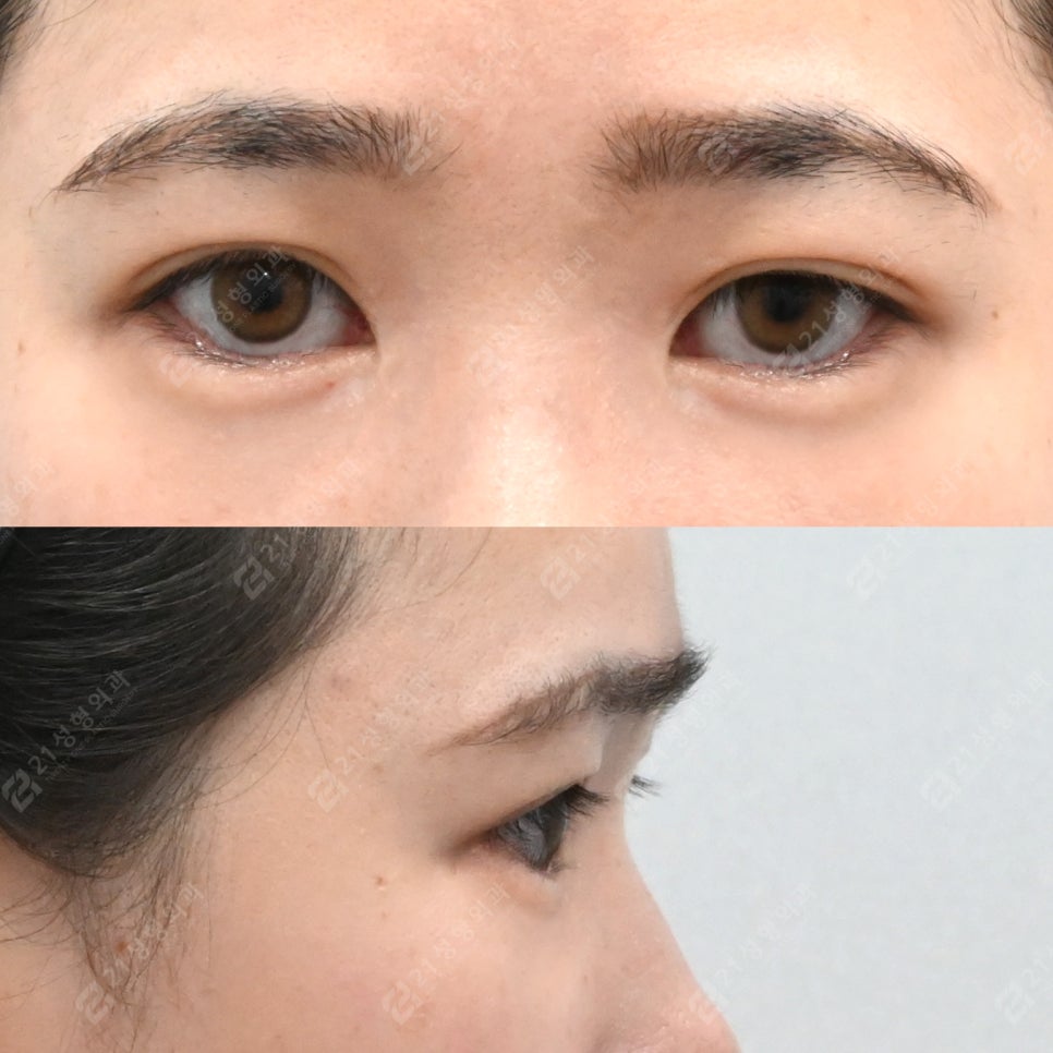 Under-eye fat that filler couldn’t hide: a 3-month and 4-month review after under-eye surgery image 3