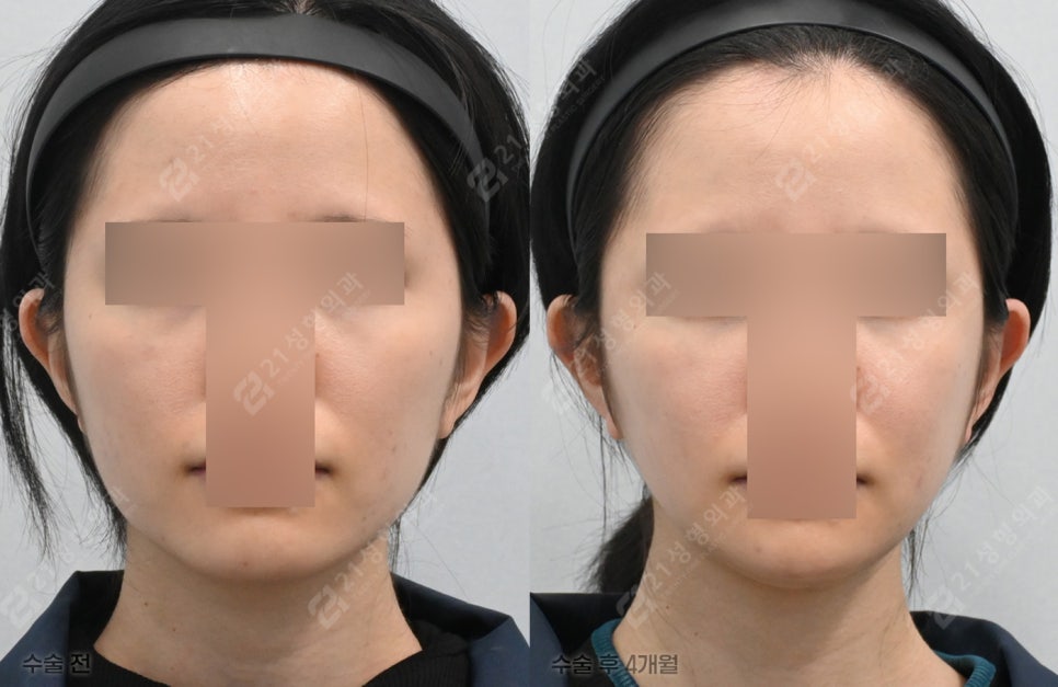 얼굴선 깎기 전에, 후회 안 하려면 꼭 알아야 할 것들(사각턱 &middot; 광대 &middot; 턱끝 A to Z) 관련 이미지 1