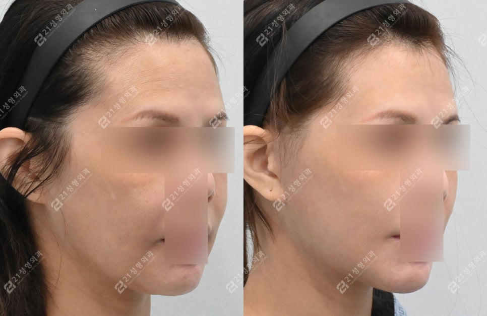 Face and Neck Lift: What Matters More Than Scars Is the Surgical Design image 5