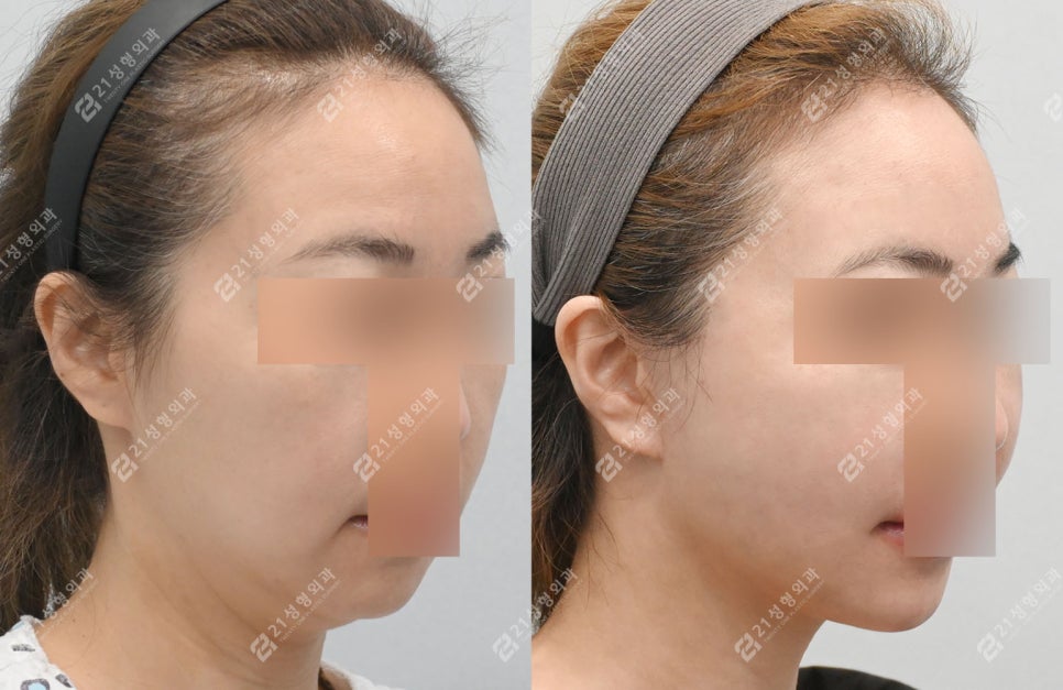 Facial and Neck Lift: The Key Is Structure, Not Skin | Real Before-and-After Review image 7