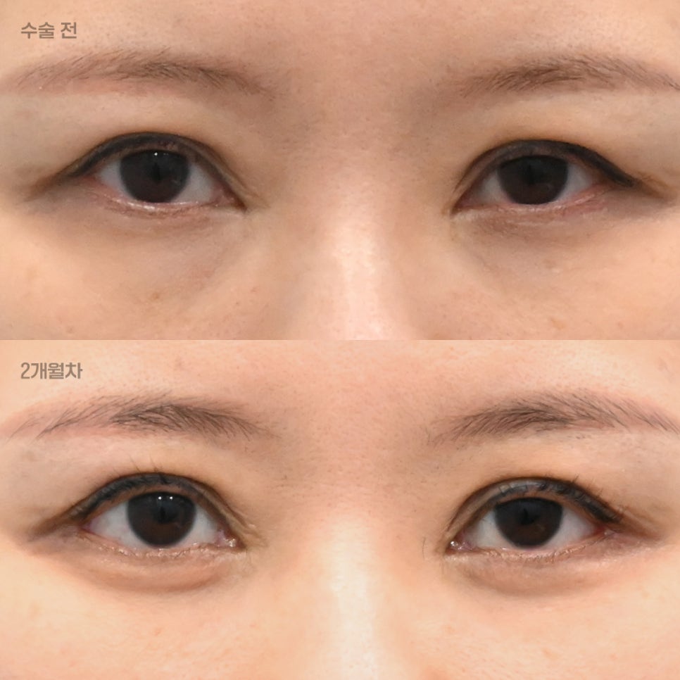 What Is the Most Efficient Combination of Plastic Surgery Procedures That Can Be Completed at Once, Without Going Through the Same Ordeal Twice? image 1