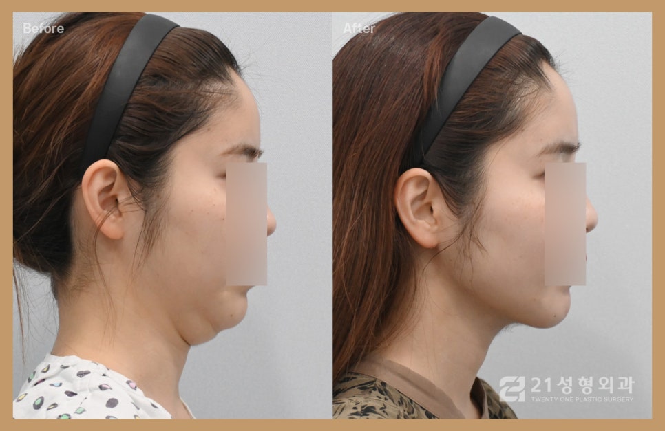 턱살제거수술로 매끈한 V라인 관련 이미지 2