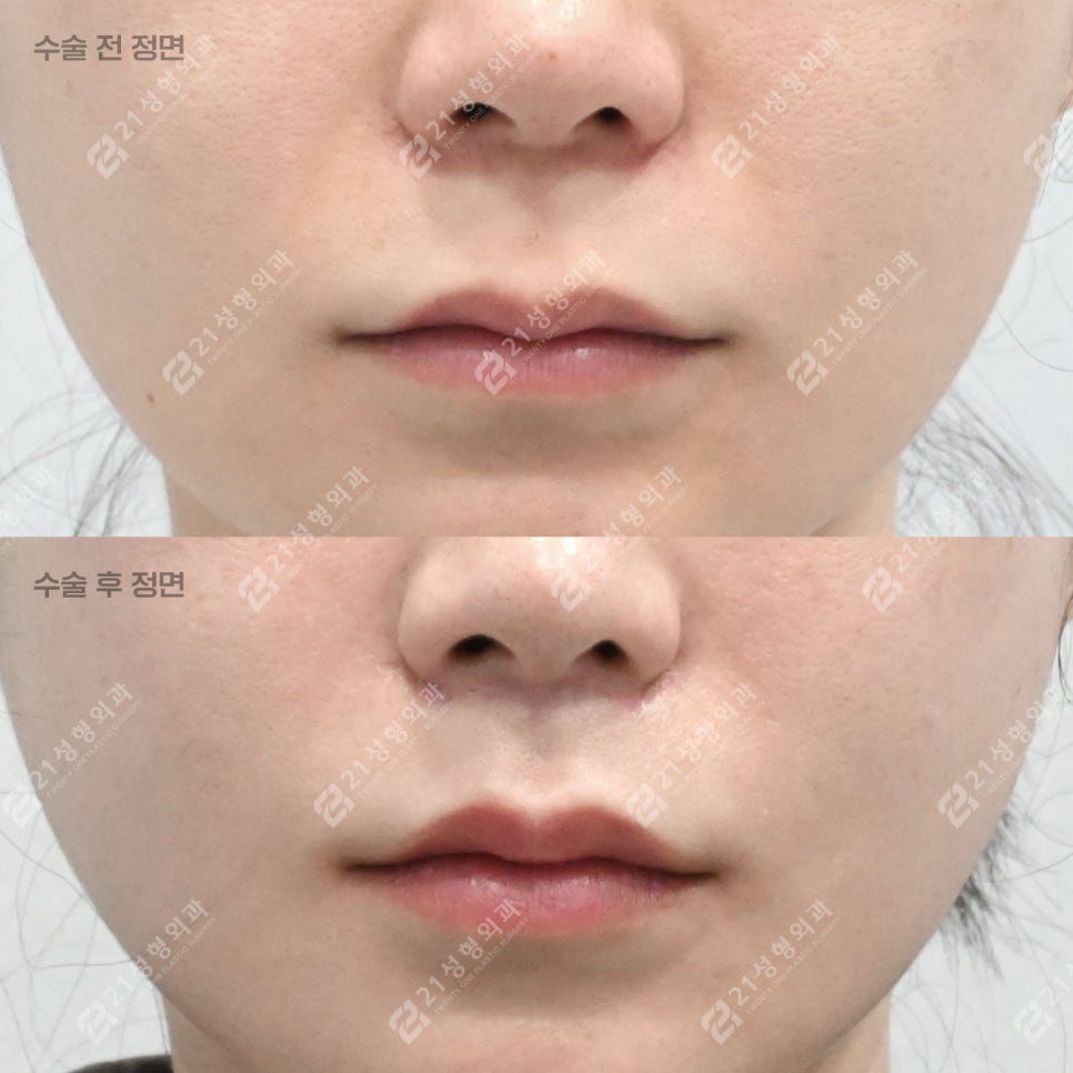 Lip Lift Review | What Matters More Than Length Is Facial Proportion! image 1