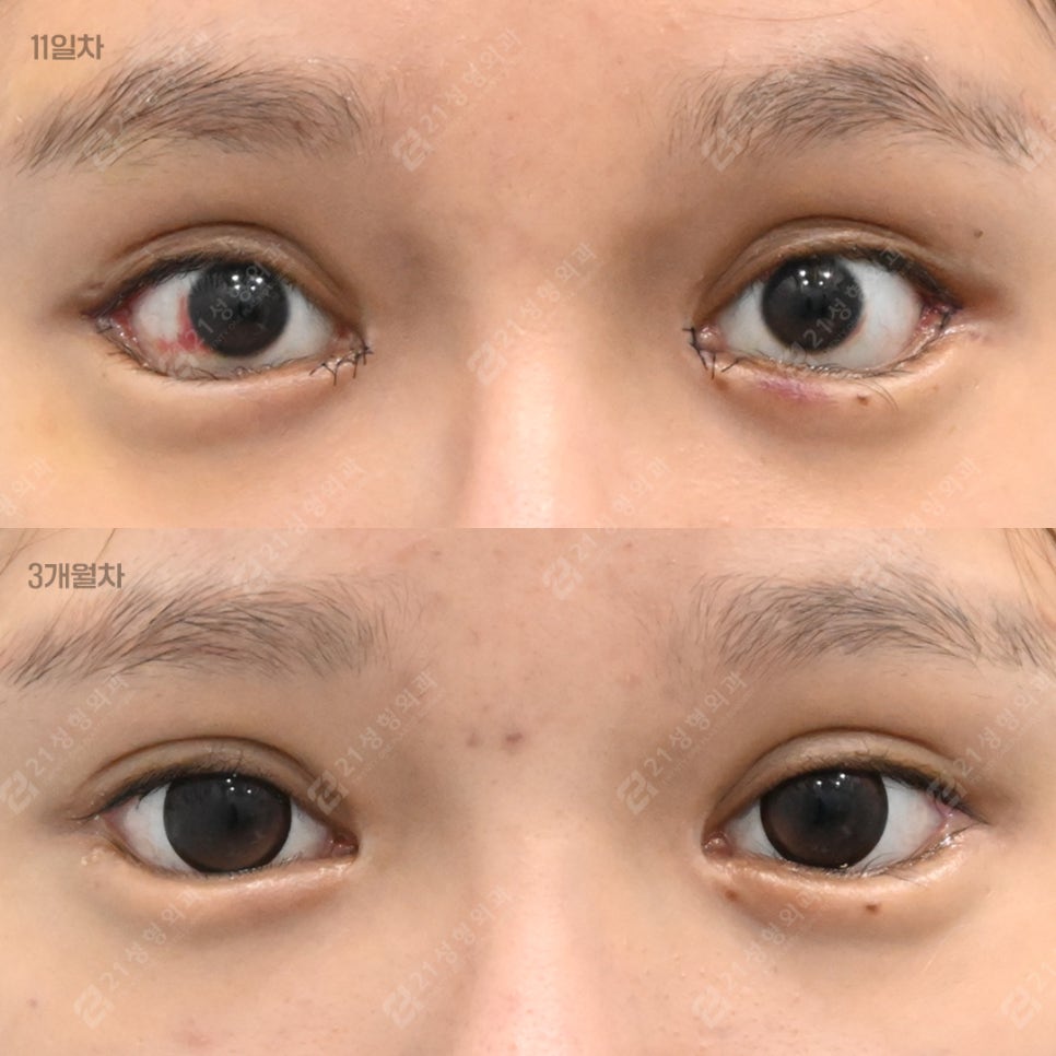 The Golden Time to Correct Failed Eye Corners? Essential Checklist for Lateral & Lower Canthoplasty Revision image 5