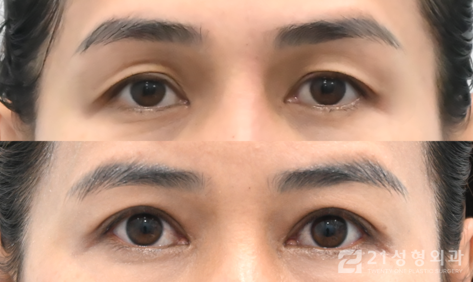 눈매교정잘하는곳 또렷해지고 싶다면 관련 이미지 1