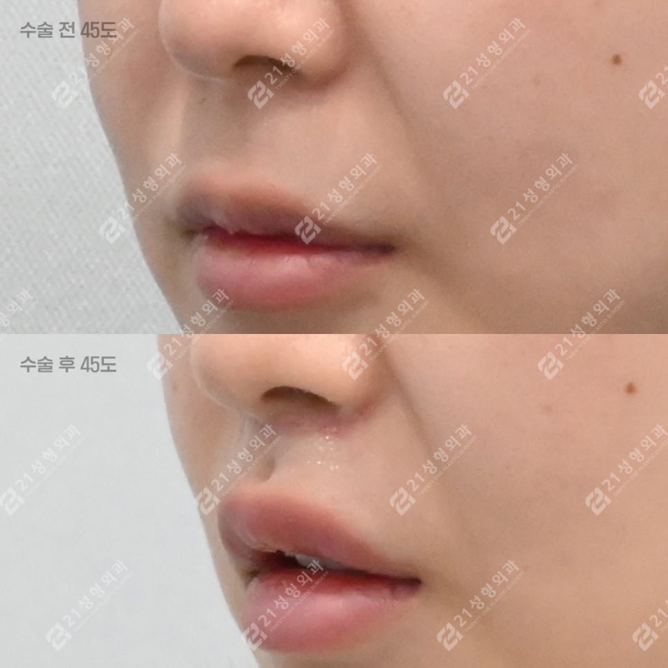 How to Make the Philtrum Look Shorter by Adding Dimension Alongside Philtrum Reduction Surgery image 2