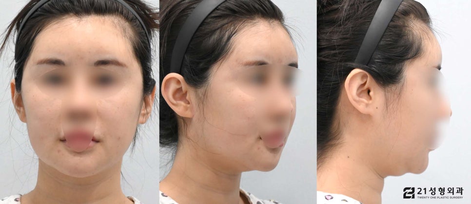 투턱없애기 이중턱근육묶기로 해결 관련 이미지 5