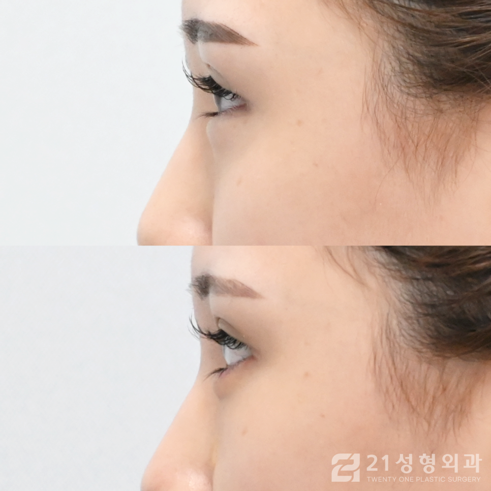 눈밑지방없애는방법 확실한 효과를 얻고 싶다면 관련 이미지 3