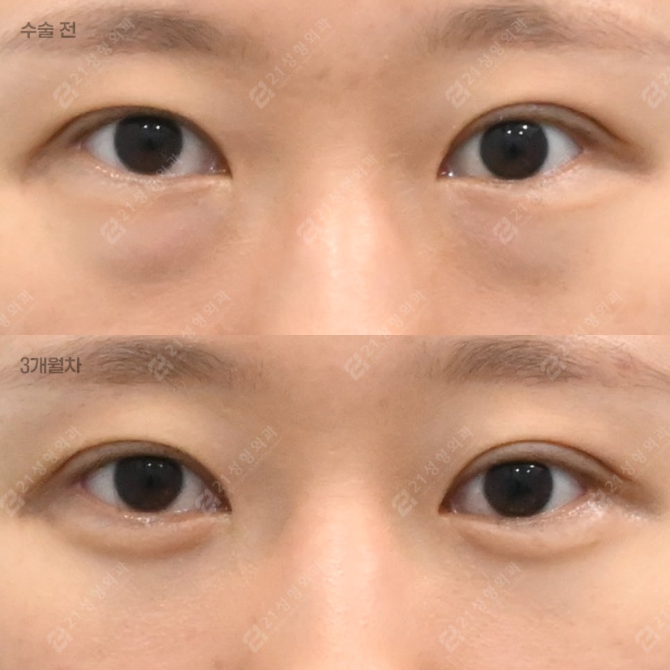 With Lower-Eyelid Fat Repositioning and Fat Grafting: The Real Reason Your Eyes Look Different image 1