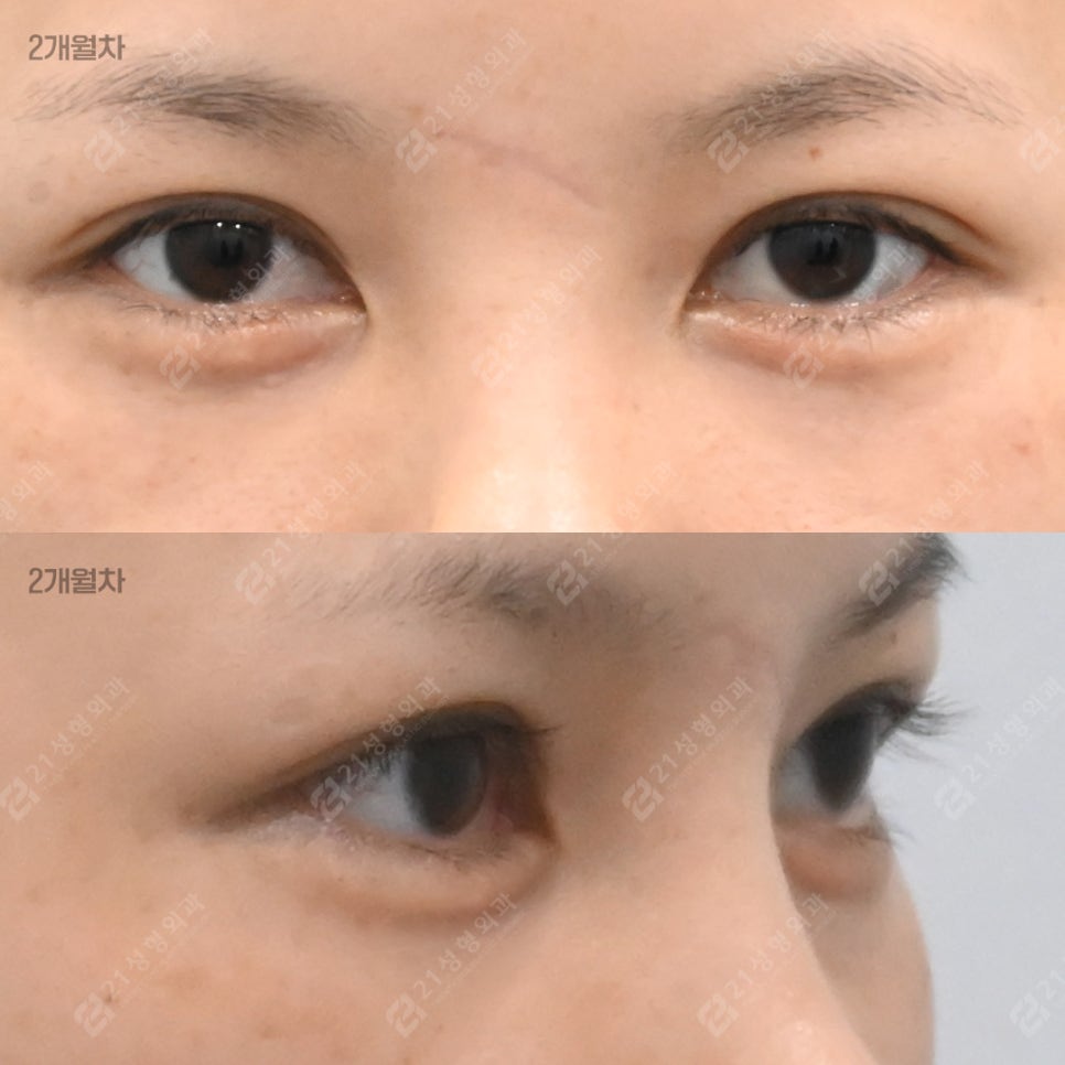 눈밑지방, 무조건 빼면 안 되는 이유 &ndash; 21성형외과 관련 이미지 3